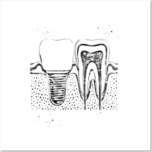 Human teeth and dental implant Posters and Art